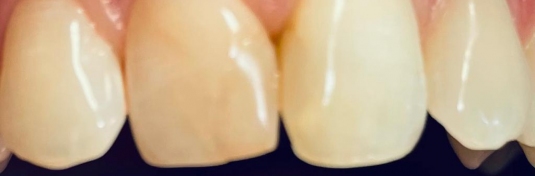 Реставрация зубов в Твери до - пример 4