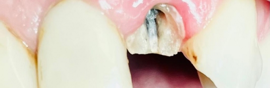 Реставрация зубов в Твери до - пример 6