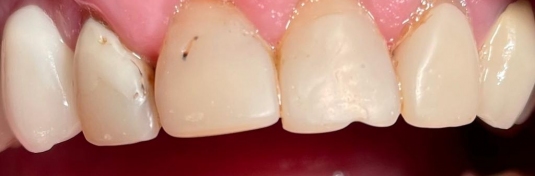 Реставрация зубов в Твери до - пример 3