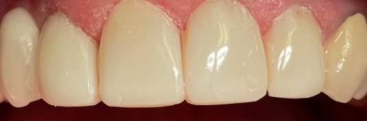 Реставрация зубов в Твери после - пример 3