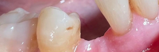 Протезирование зубов в Твери до - пример 2