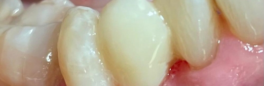 Протезирование зубов в Твери после - пример 2