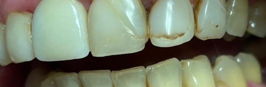 Реставрация зубов в Твери до - пример 2