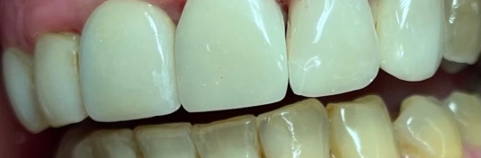 Реставрация зубов в Твери после - пример 2