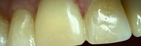 Реставрация зубов в Твери после - пример 7