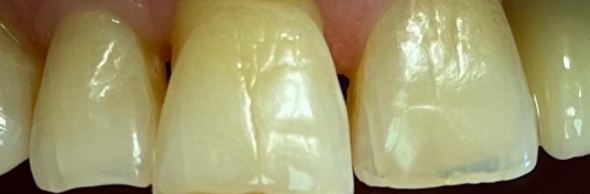 Реставрация зубов в Твери до - пример 7