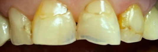 Реставрация зубов в Твери до - пример 1