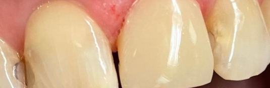 Реставрация зубов в Твери после - пример 5
