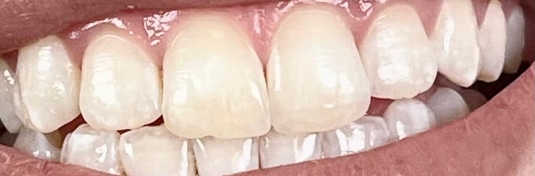 Отбеливание зубов в Твери после - пример 3