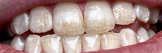 Отбеливание зубов в Твери до - пример 3