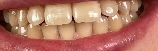 Отбеливание зубов в Твери до - пример 1