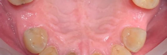 Протезирование зубов в Твери до - пример 1