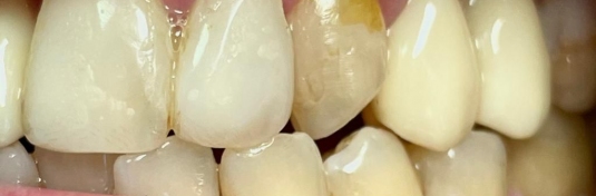 Реставрация зубов в Твери до - пример 9
