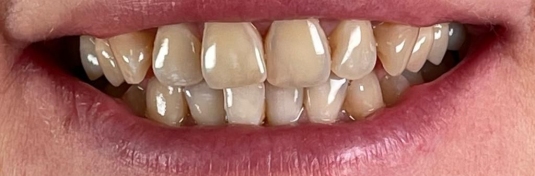 Отбеливание зубов в Твери до - пример 4