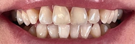 Отбеливание зубов в Твери после - пример 4