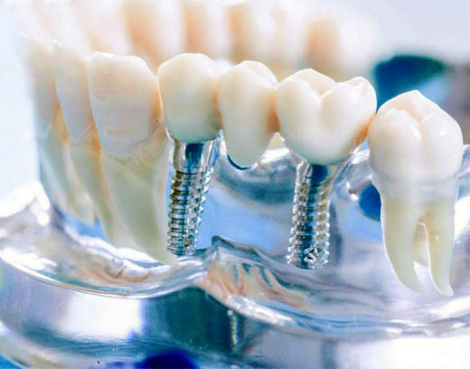 Протезирование зубов в Твери в стоматологии доктора Афанасьевой