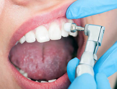 Этапы реставрации зубов