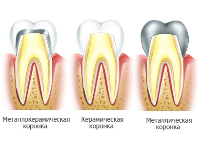 Преимущества и недостатки металлокерамической коронки